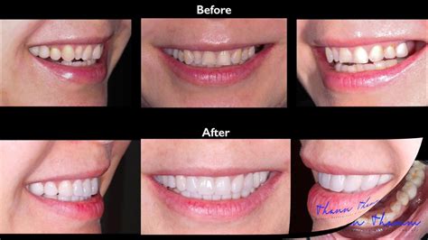 Implant Dentist Consultation in Cambodia • Check Prices & Reviews.